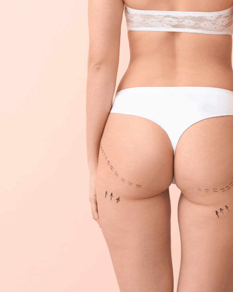 cryolipolyse fettwegfrieren