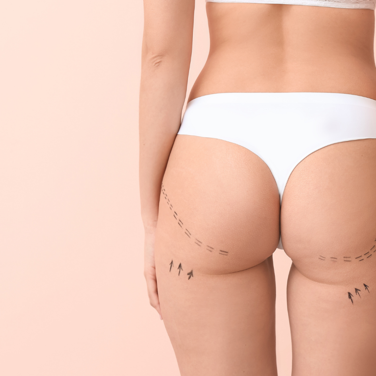 cryolipolyse fettwegfrieren